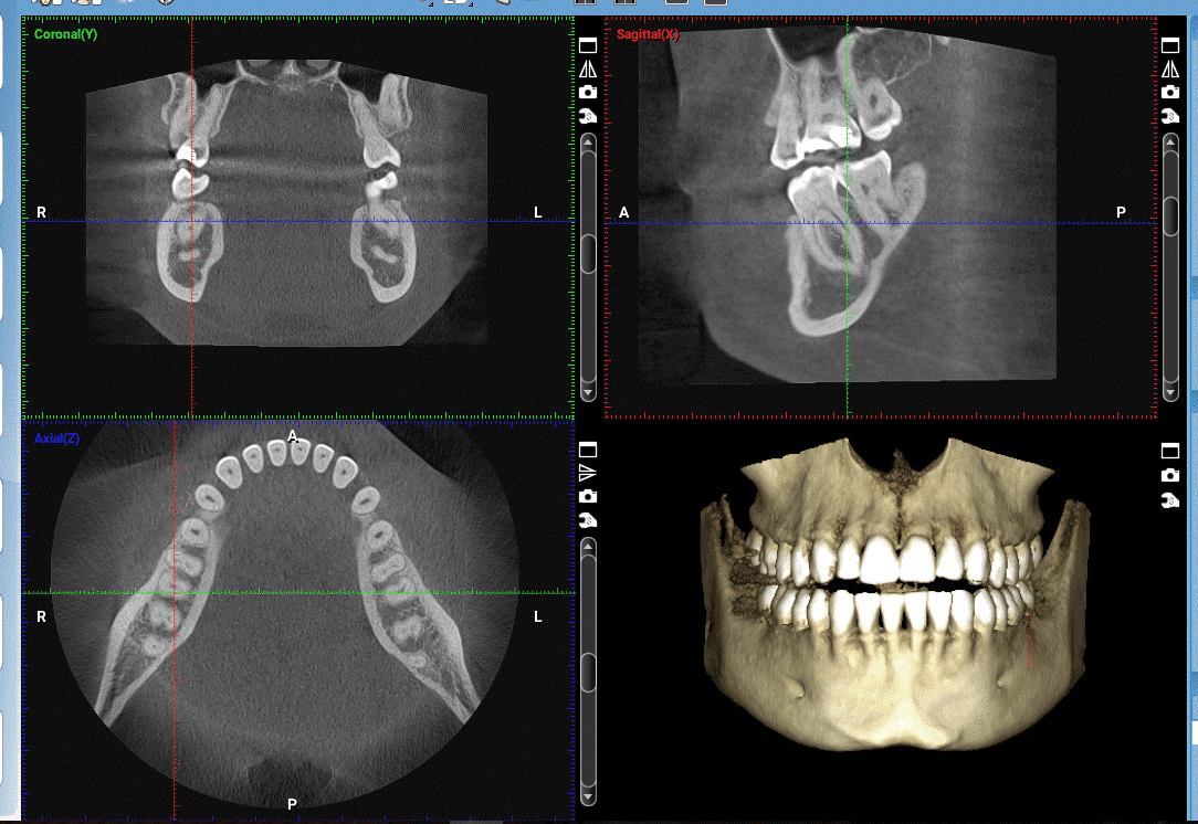 رادیوگرافی cbct چیست و چه کاربردی دارد؟ - مجله چرخونکی