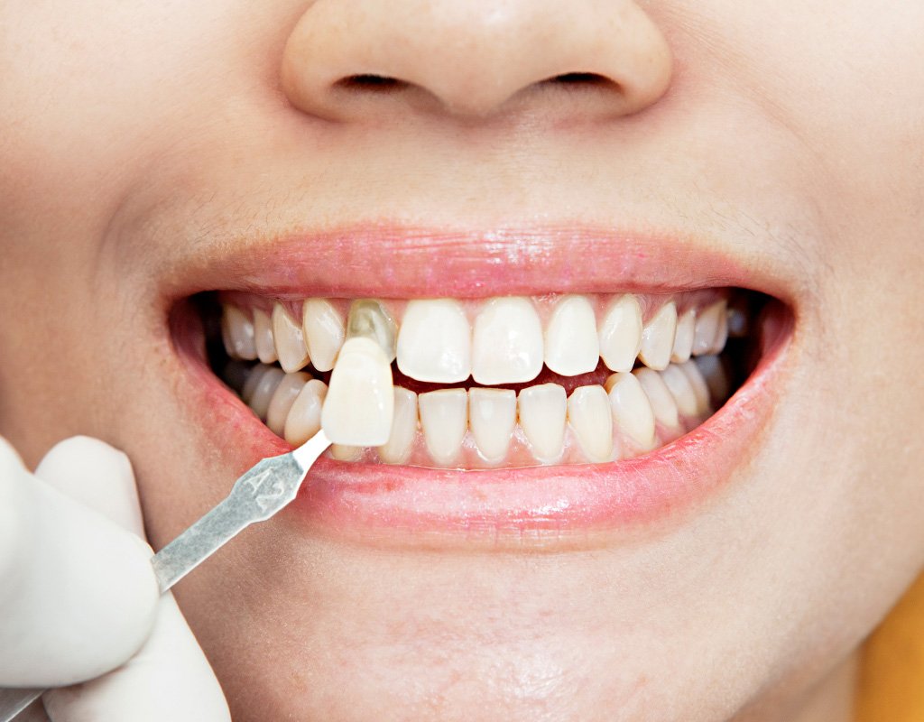 تعیین تعداد واحد کامپوزیت دندان