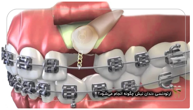 ارتودنسی دندان نیش توسط دکتر قاسمی چگونه انجام می‌شود؟