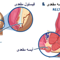 تفاوت فیستول و آبسه مقعدی