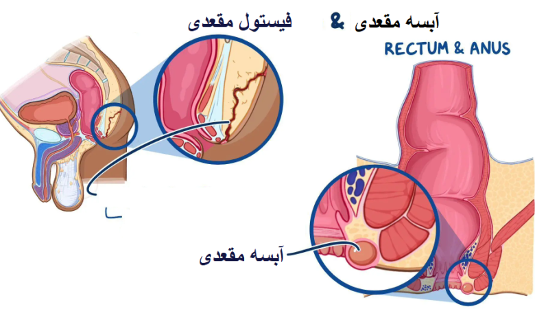 تفاوت فیستول و آبسه مقعدی