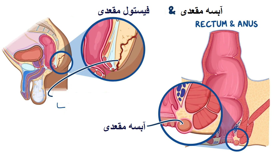 تفاوت فیستول و آبسه مقعدی