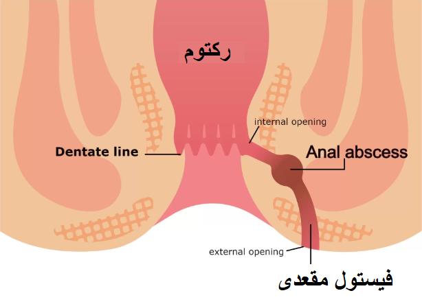 فیستول چیست