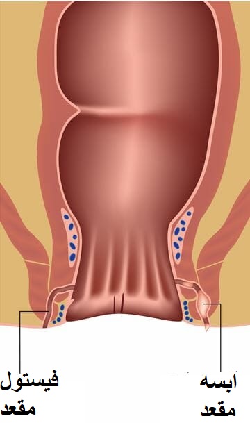 تفاوت فیستول و آبسه