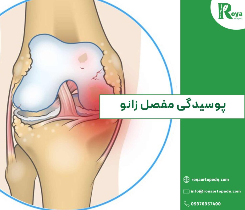 پوسیدگی مفصل زانو