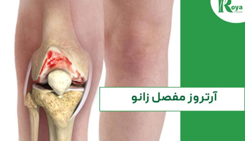 آرتروز مفصل زانو