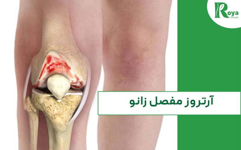 آرتروز مفصل زانو