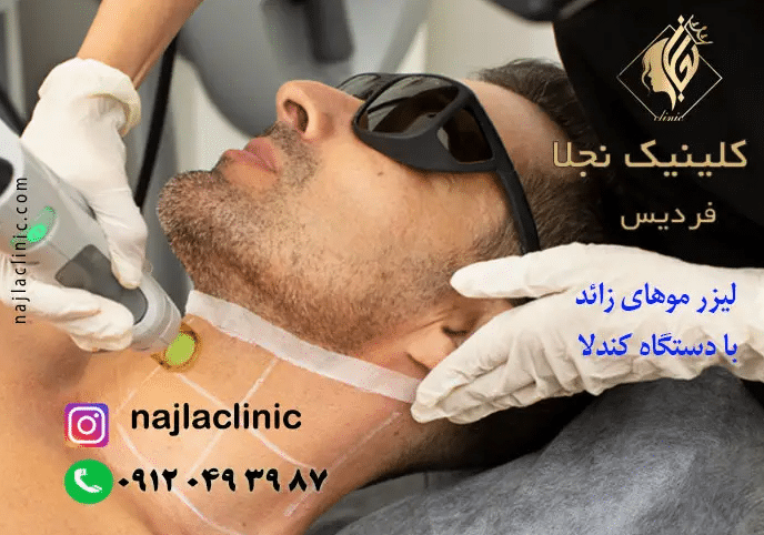 لیزر موهای زائد مردان در فردیس