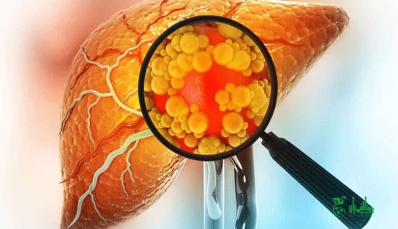 کبد چرب انسان زیر ذره بین