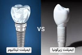 ایمپلنت دندان چیست و چرا اهمیت دارد؟
