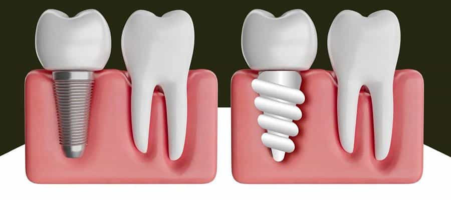 چرا انتخاب بهترین دکتر ایمپلنت در ارومیه مهم است؟