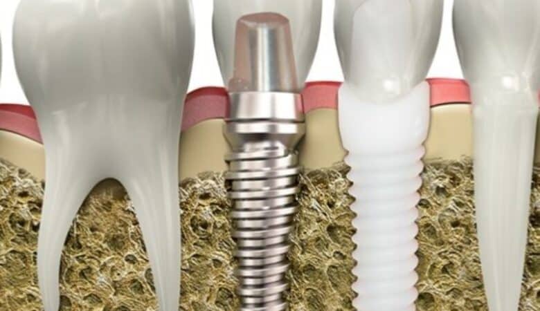 مقایسه ایمپلنت زیرکونیا با تیتانیوم