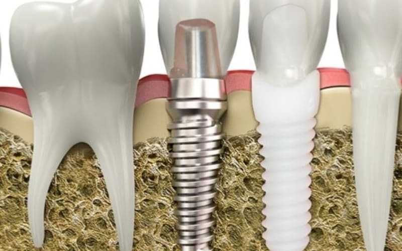 مقایسه ایمپلنت زیرکونیا با تیتانیوم